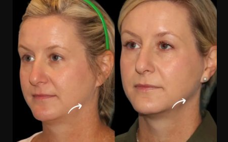How the Best Plastic Surgeons in Dubai Are Revolutionizing Anti-Aging with Sculptra Fillers