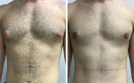 Everything You Need to Know About Scarring After Gynecomastia Surgery in Dubai
