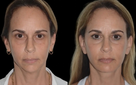 Why Choose the Best Plastic Surgeons in Dubai for Your Chin Fillers Procedure