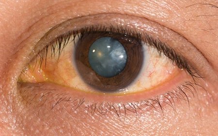 Cost for Eye Laser Treatment: A Quick Guide