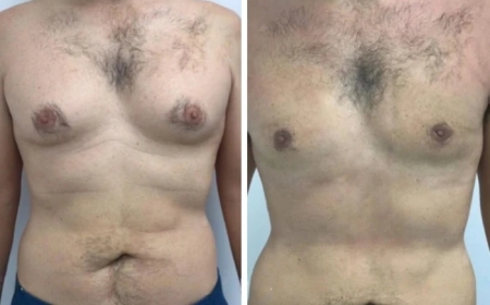 Why the Best Gynecomastia Surgeon in Dubai Delivers Exceptional Results
