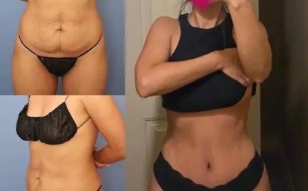 How to Choose the Best Tummy Tuck Surgeon in Dubai for Natural Results