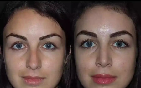 Best Septoplasty Surgeon in Dubai for Complex Nose Surgeries