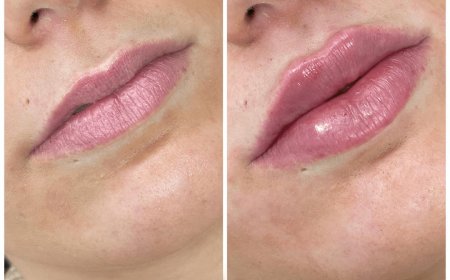 How Dermal Fillers Can Improve Your Appearance Without Surgery: A Guide from the Best Doctors in Dubai