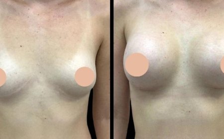 Breast Augmentation in Dubai: How to Choose the Right Implant Size and Shape