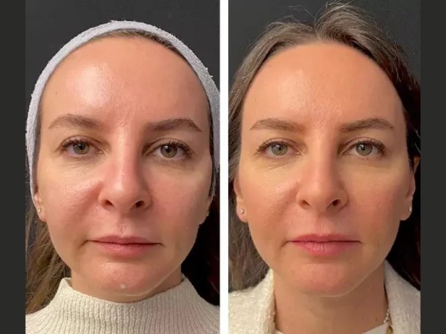The Best Plastic Surgeons in Dubai Reveal the Secrets of Mesotherapy for Acne Scars