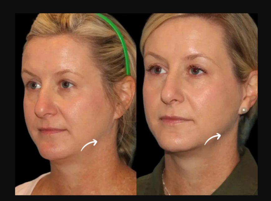 How the Best Plastic Surgeons in Dubai Are Revolutionizing Anti-Aging with Sculptra Fillers