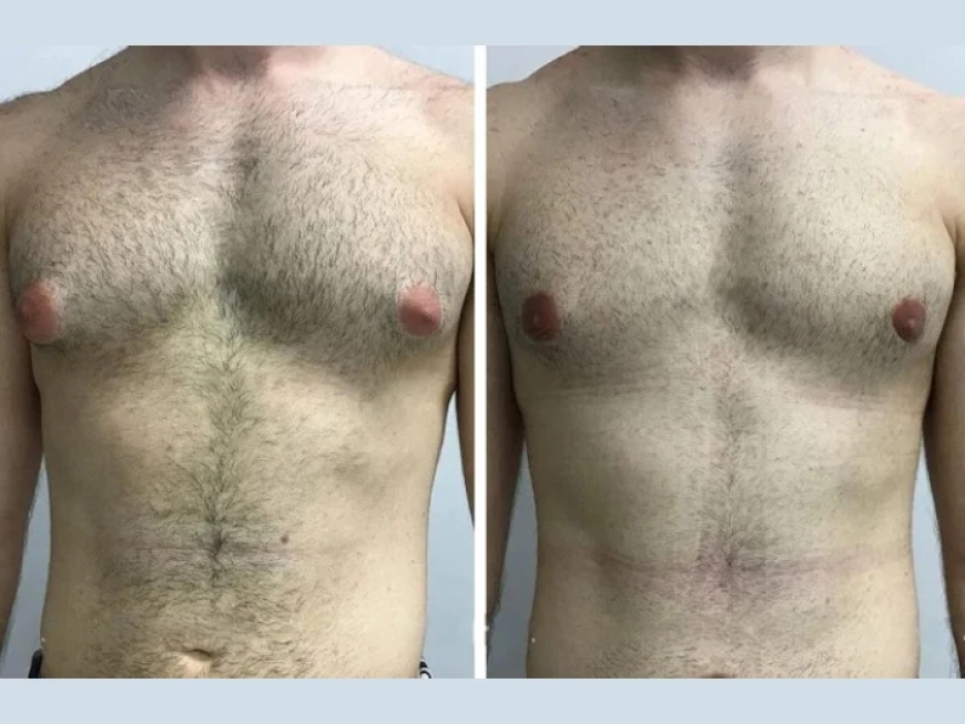 Everything You Need to Know About Scarring After Gynecomastia Surgery in Dubai