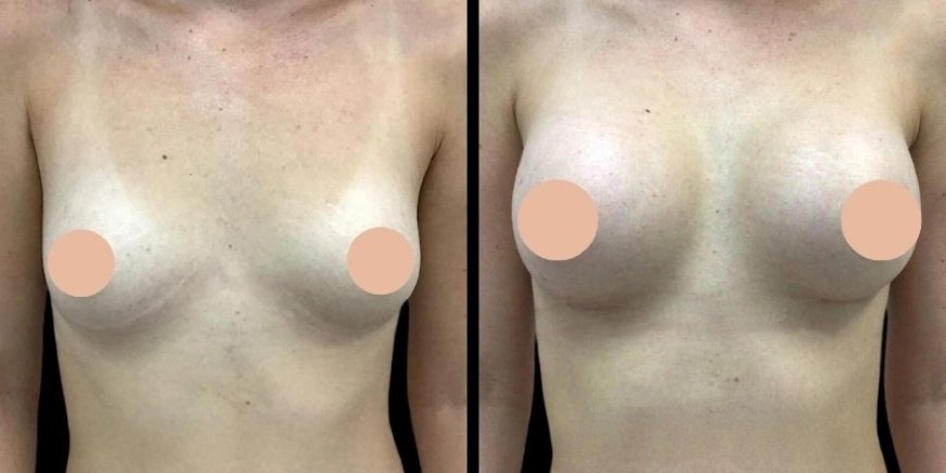 Recovery Timeline After Breast Augmentation Surgery in Dubai