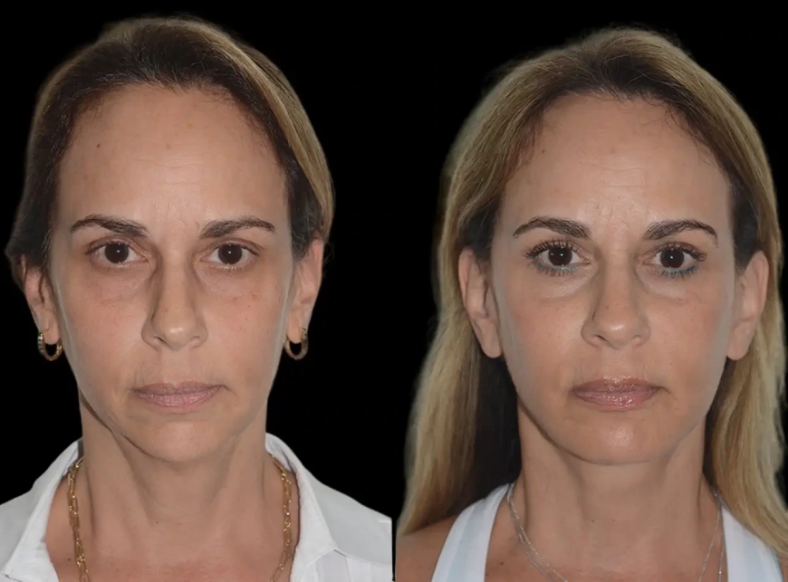 Why Choose the Best Plastic Surgeons in Dubai for Your Chin Fillers Procedure