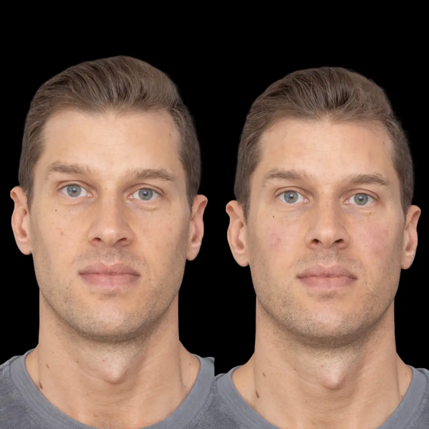 Best Plastic Surgeons in Dubai for Jawline Enhancement: The Power of Fillers