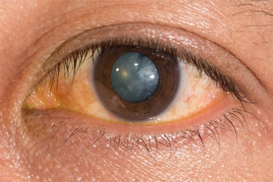 Cost for Eye Laser Treatment: A Quick Guide
