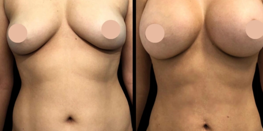 Journey to Confidence: Best Breast Augmentation Surgeon in Dubai