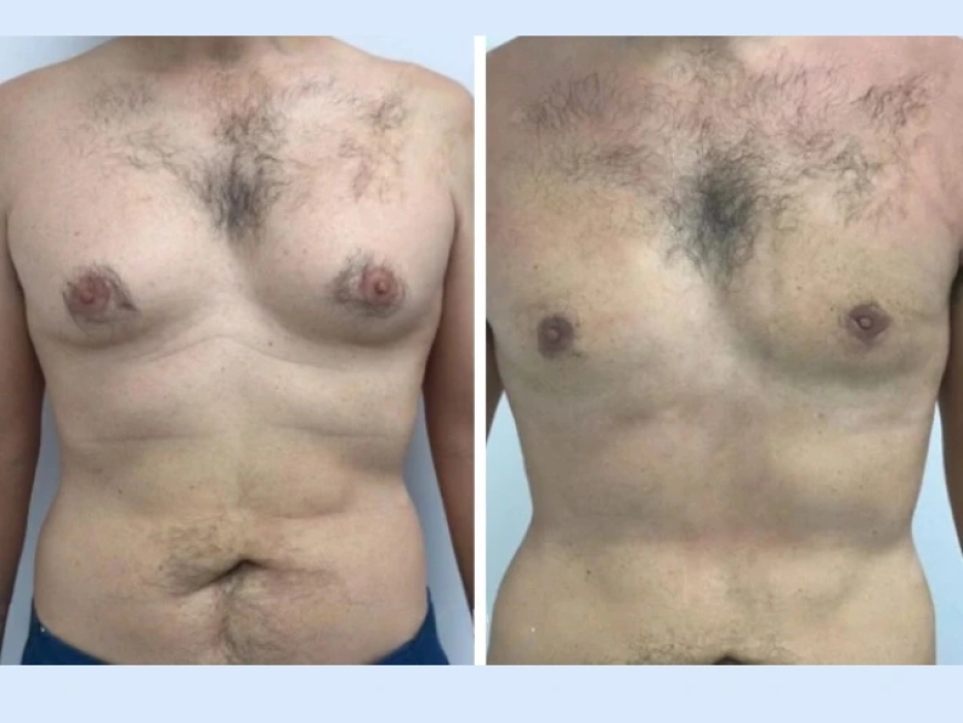 Why the Best Gynecomastia Surgeon in Dubai Delivers Exceptional Results