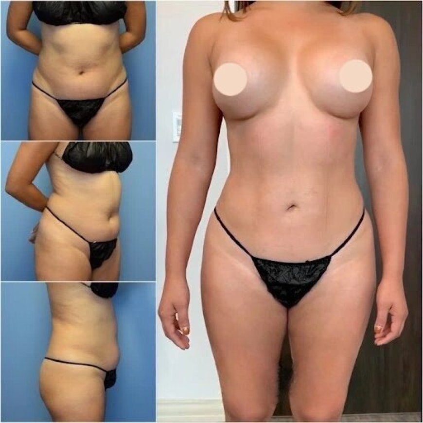 Sculpt Your Ideal Body Shape with the Best Body Contouring Surgeon in Dubai