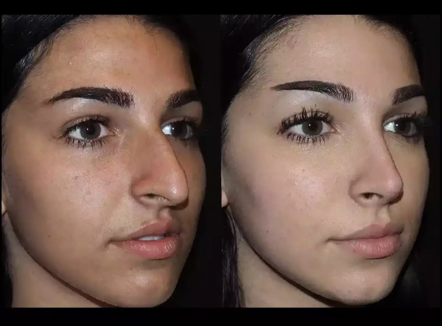 Female Rhinoplasty: Best Rhinoplasty Surgeon in Dubai for Women