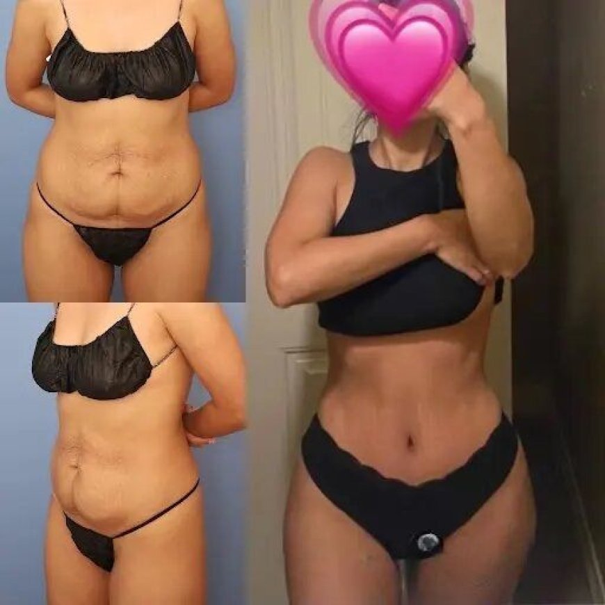 How to Choose the Best Tummy Tuck Surgeon in Dubai for Natural Results