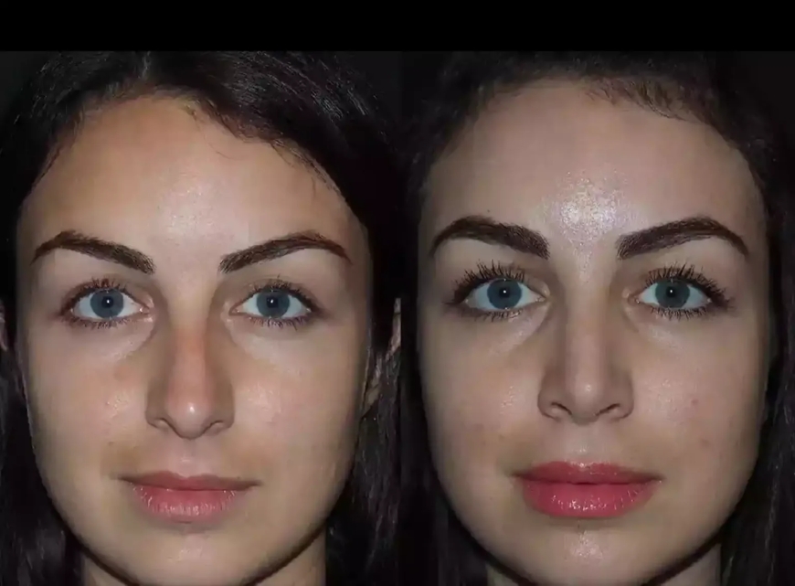 Best Septoplasty Surgeon in Dubai for Complex Nose Surgeries