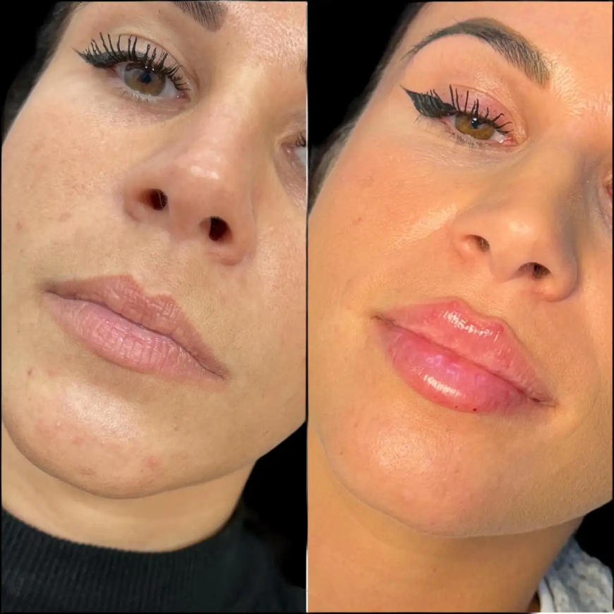 Discover Safe and Effective Dermal Fillers Treatment in Dubai