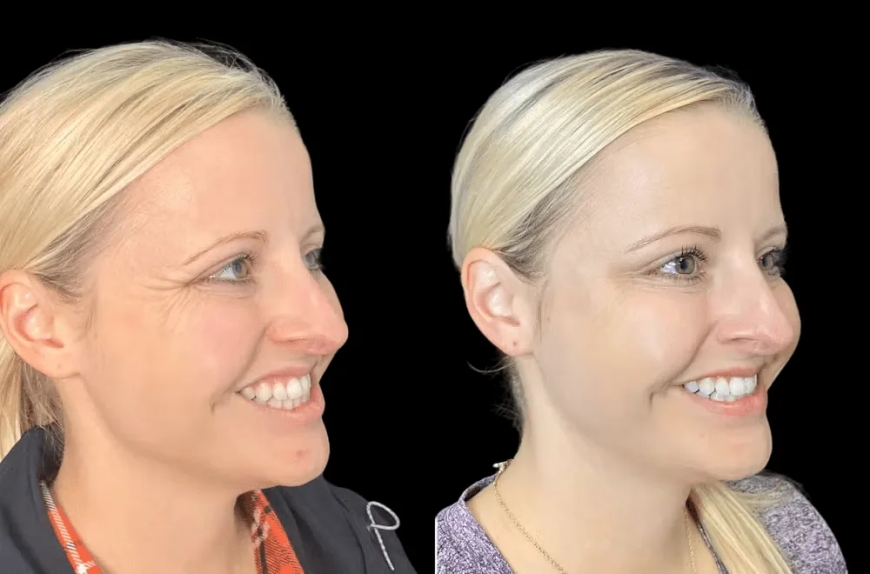 Natural Botox Results: Techniques Used by the Best Doctors in dubai