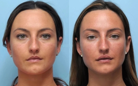 Achieve Younger-Looking Skin with the Best Plastic Surgeon in Dubai for Thread Lift