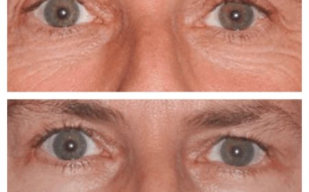 Top 5 Questions to Ask the Best Eye Bag Removal Surgeon in Dubai