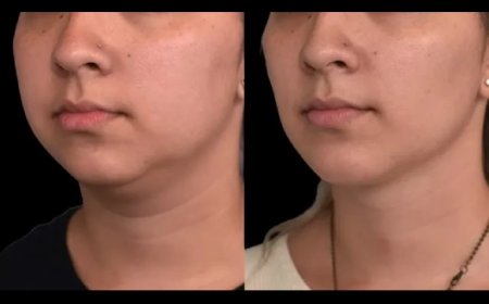 How Double Chin Removal Surgery Can Give You a More Youthful Appearance: Insights from the Best Double Chin Removal Surgeon in Dubai
