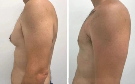 The Best Gynecomastia Surgeons in Dubai: Why They Deliver Exceptional Aesthetic Results