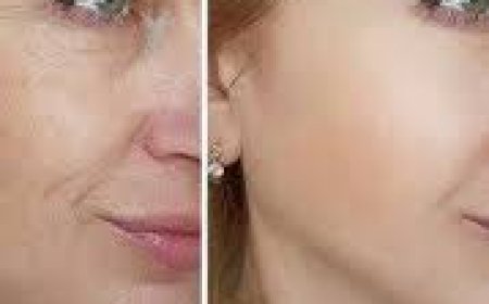 The Gentle Lift: How Laser Skin Tightening Rewinds Time Without Surgery