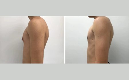 How the Best Gynecomastia Surgeon in Dubai Personalizes Gynecomastia Surgery
