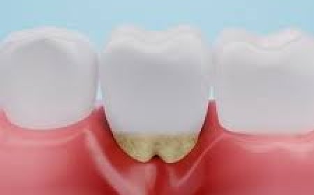 Root Canal Treatment Cost: What to Expect and How to Budget