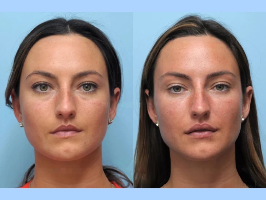 Why Beauty Seekers Trust the Best Aesthetic Clinic in Dubai for Thread Lifts