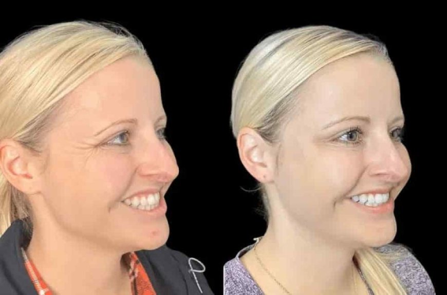 Why the Best Aesthetic Clinic in Dubai for Botox Is Changing the Game