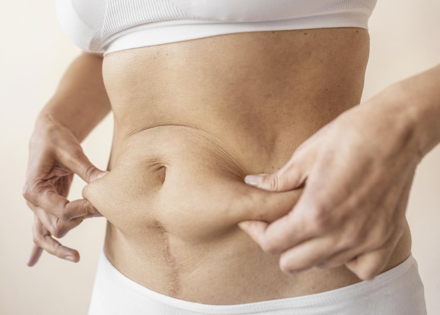 Liposuction Success Through a Best Liposuction Surgeon in Dubai