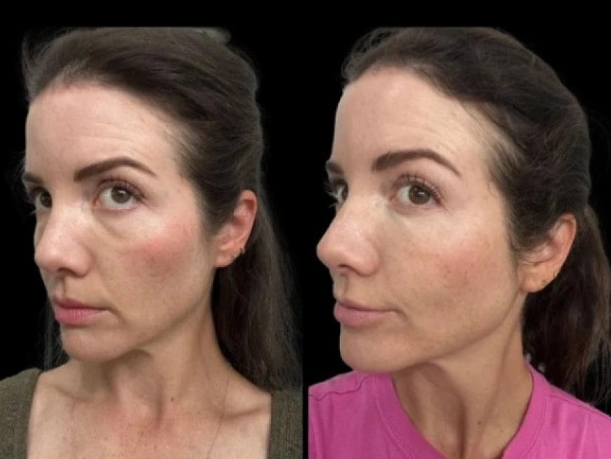Dark Circles Treatment in Dubai: How to Choose the Right Treatment for Your Skin Type