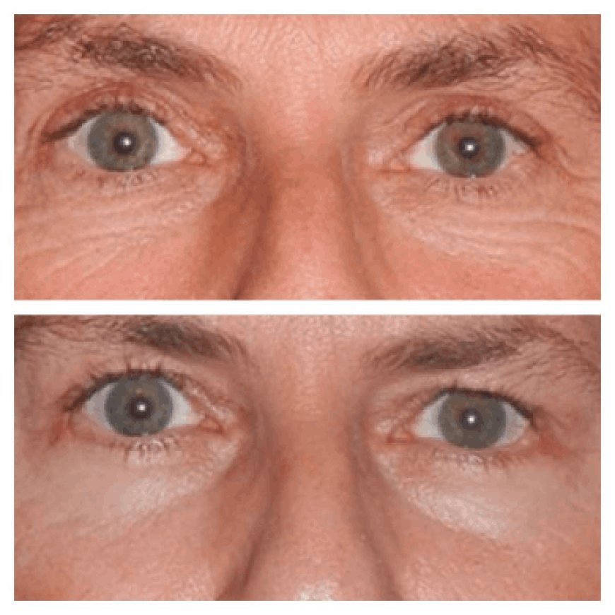 Top 5 Questions to Ask the Best Eye Bag Removal Surgeon in Dubai