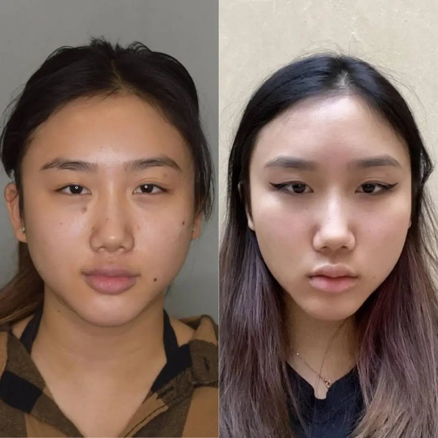 How to Boost Healing After Buccal Fat Removal by the Best Buccal Fat Removal Surgeon in Dubai