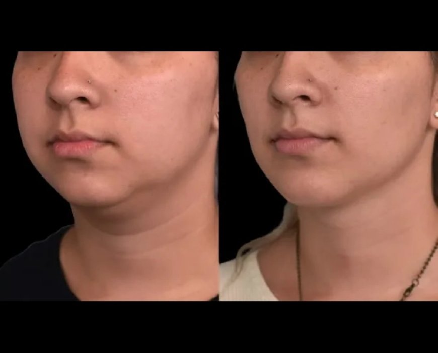 How Double Chin Removal Surgery Can Give You a More Youthful Appearance: Insights from the Best Double Chin Removal Surgeon in Dubai