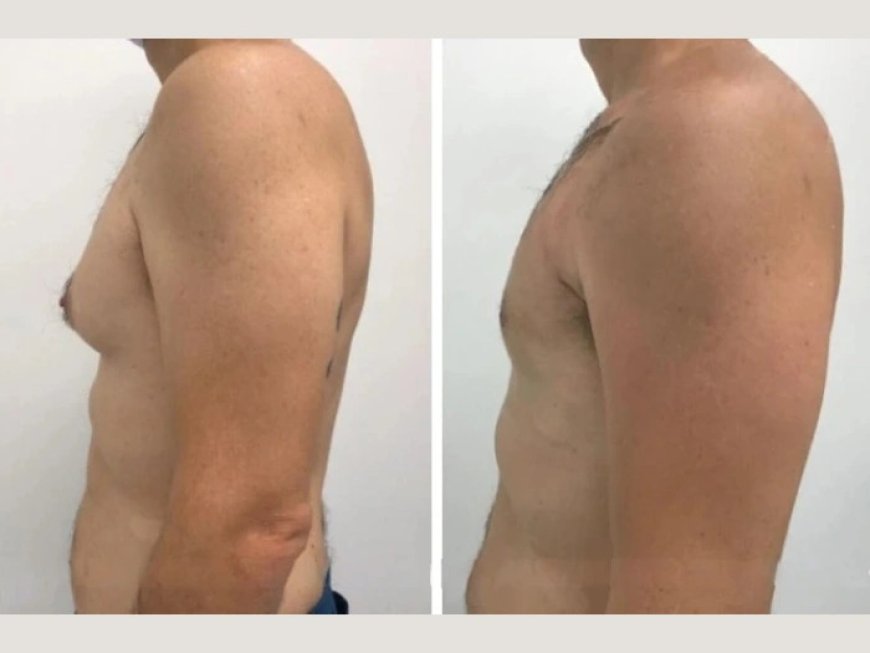 The Best Gynecomastia Surgeons in Dubai: Why They Deliver Exceptional Aesthetic Results