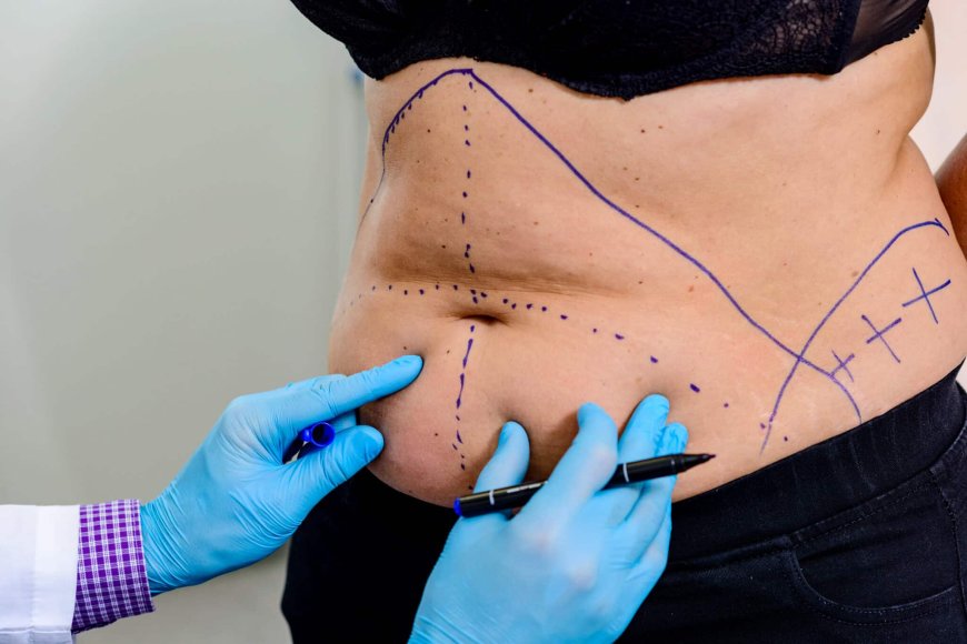 Complete Transformation Awaits: What to Expect from a Mommy Makeover