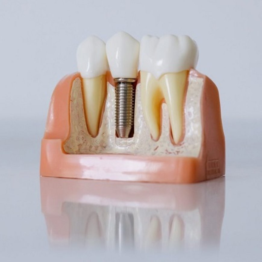 Say No to Tooth Shifting with Implants
