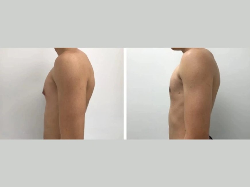 How the Best Gynecomastia Surgeon in Dubai Personalizes Gynecomastia Surgery