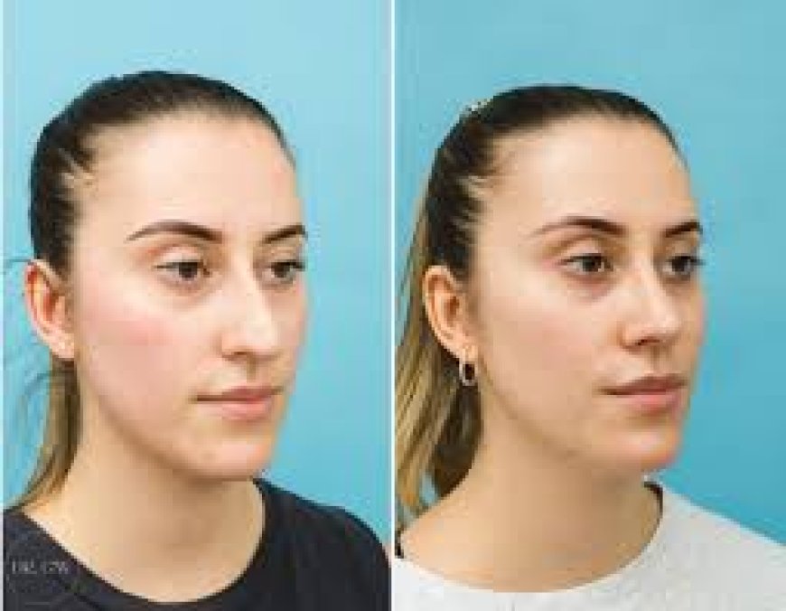 Balancing Beauty: The Rise of Rhinoplasty in Modern Aesthetics